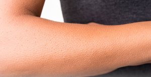 درمان پوست مرغی