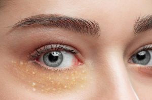 درمان خانگی میلیا چشم