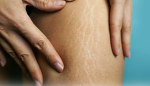 درمان سلولیت پوست