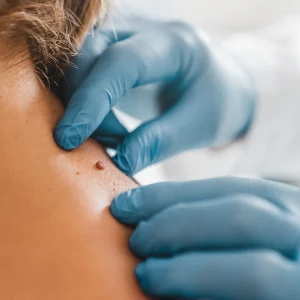 زائده گوشتی روی پوست