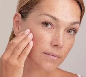 درمان لک قهوه ای صورت