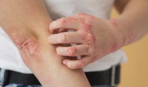 قاتل پسوریازیس