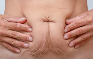 درمان افتادگی پوست بعد از لاغری