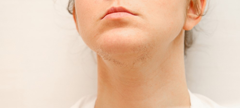 درمان پرمویی زنان