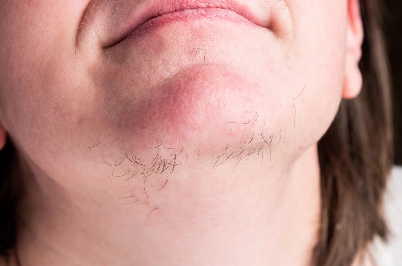 پرمویی چانه - پرمویی زنان