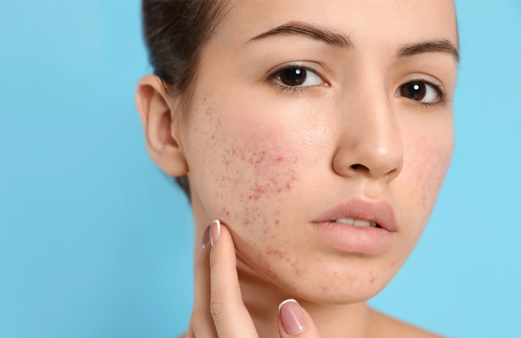 جوش صورت - درمان جای جوش عمیق