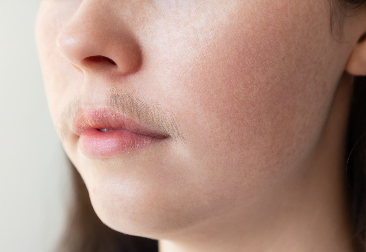 علت پرمویی زنان