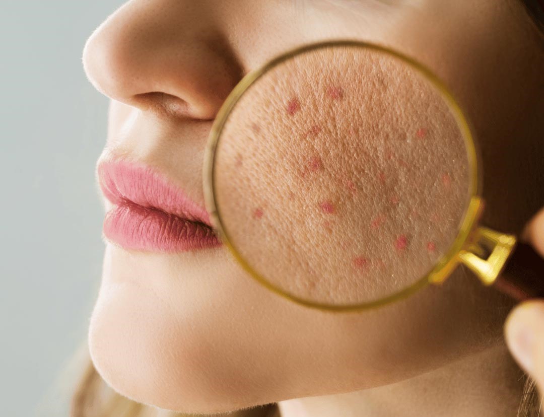 جوش های عمیق - درمان جای جوش عمیق