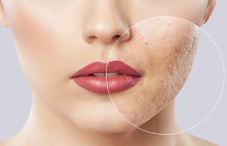 درمان جای جوش عمیق