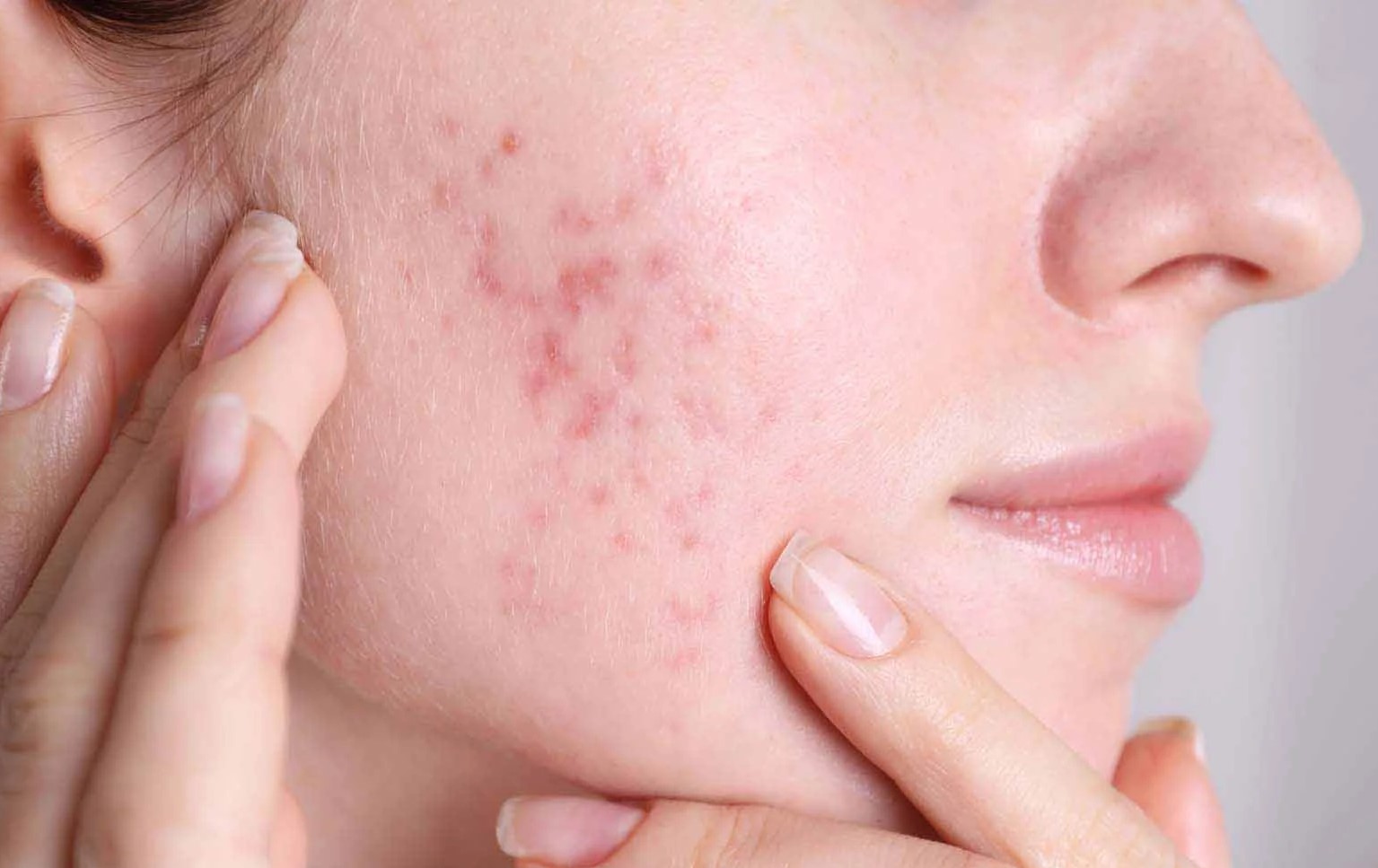 سریع ترین روش درمان جوش صورت - درمان جای جوش عمیق