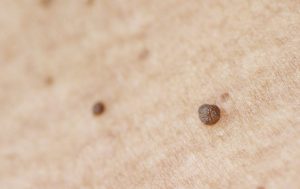 از بین بردن خال گوشتی با لاک