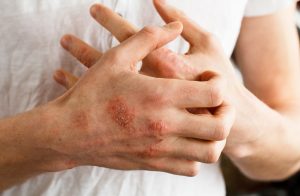 قاتل پسوریازیس