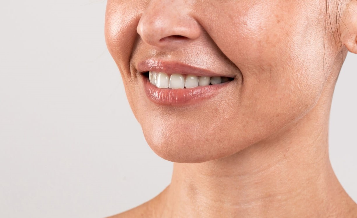 خط خنده - از بین بردن خط خنده