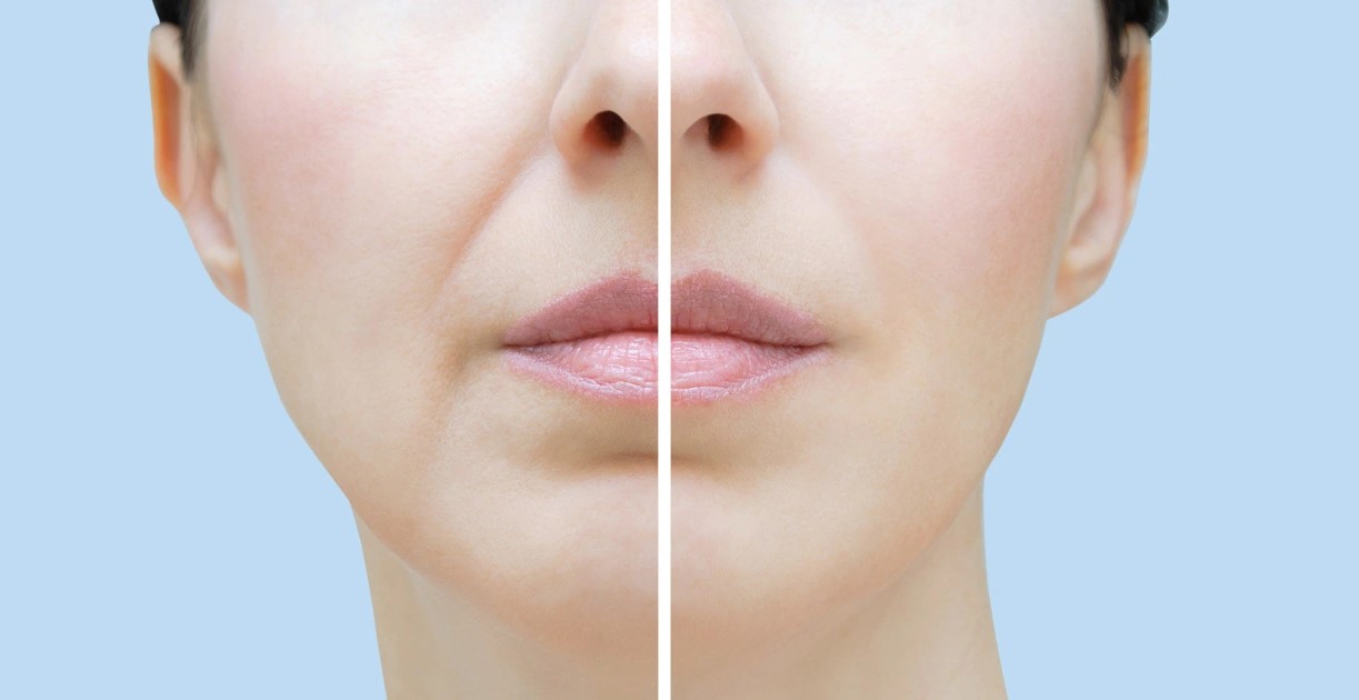 رفع خط خنده - از بین بردن خط خنده