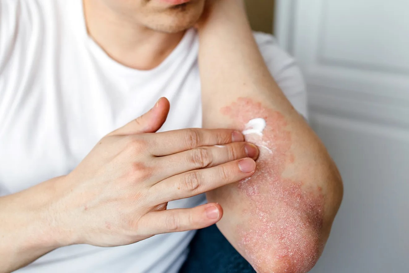 درمان خانگی پسوریازیس آرنج