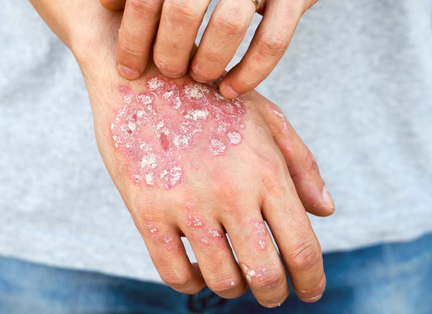 درمان خانگی پسوریازیس پشت دست