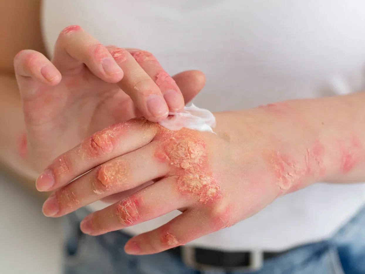 درمان خانگی پسوریازیس پوست