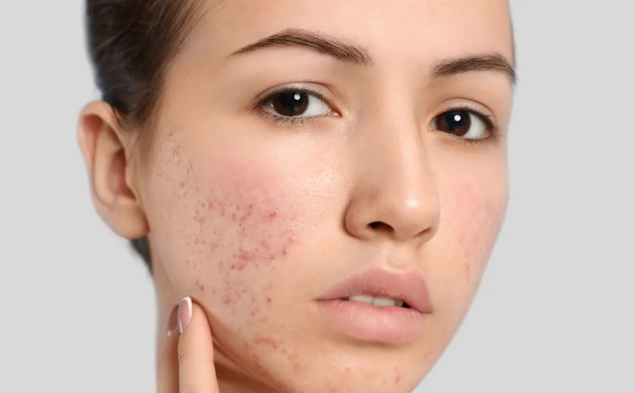 عوارض کمبود ویتامین - کمبود ویتامین و لک صورت