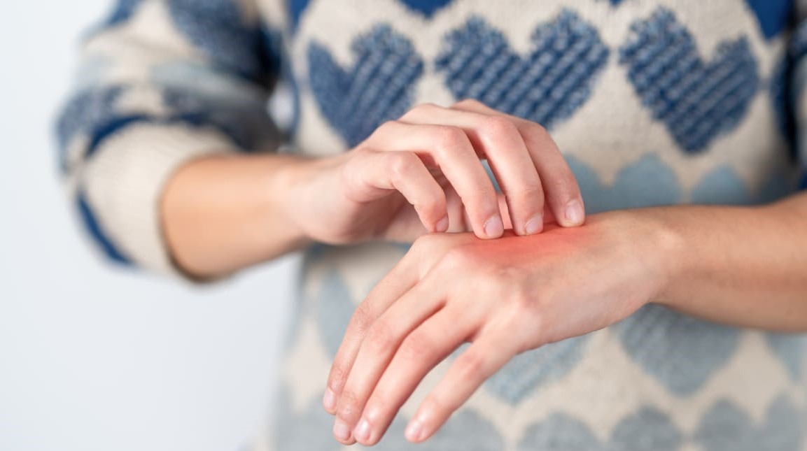 درمان خانگی پسوریازیس دست