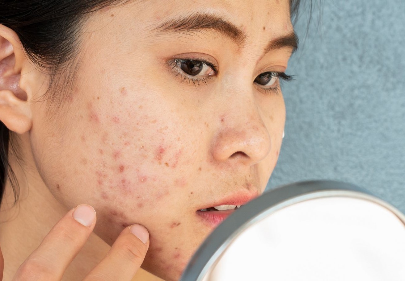 لک صورت - کمبود ویتامین و لک صورت