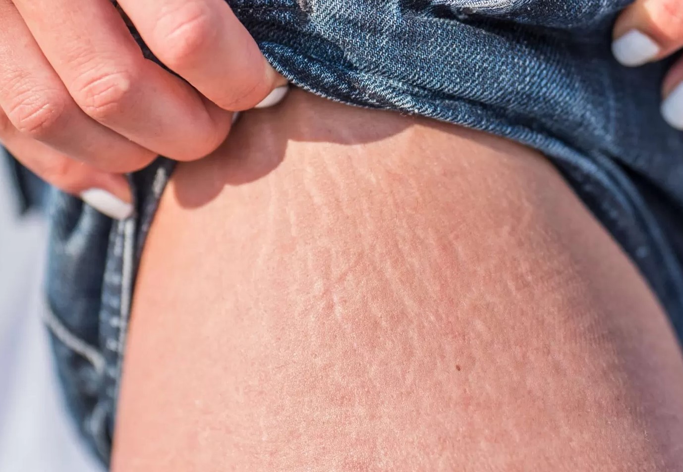 ترک پوستی ران - درمان ترک پوستی ناشی از چاقی