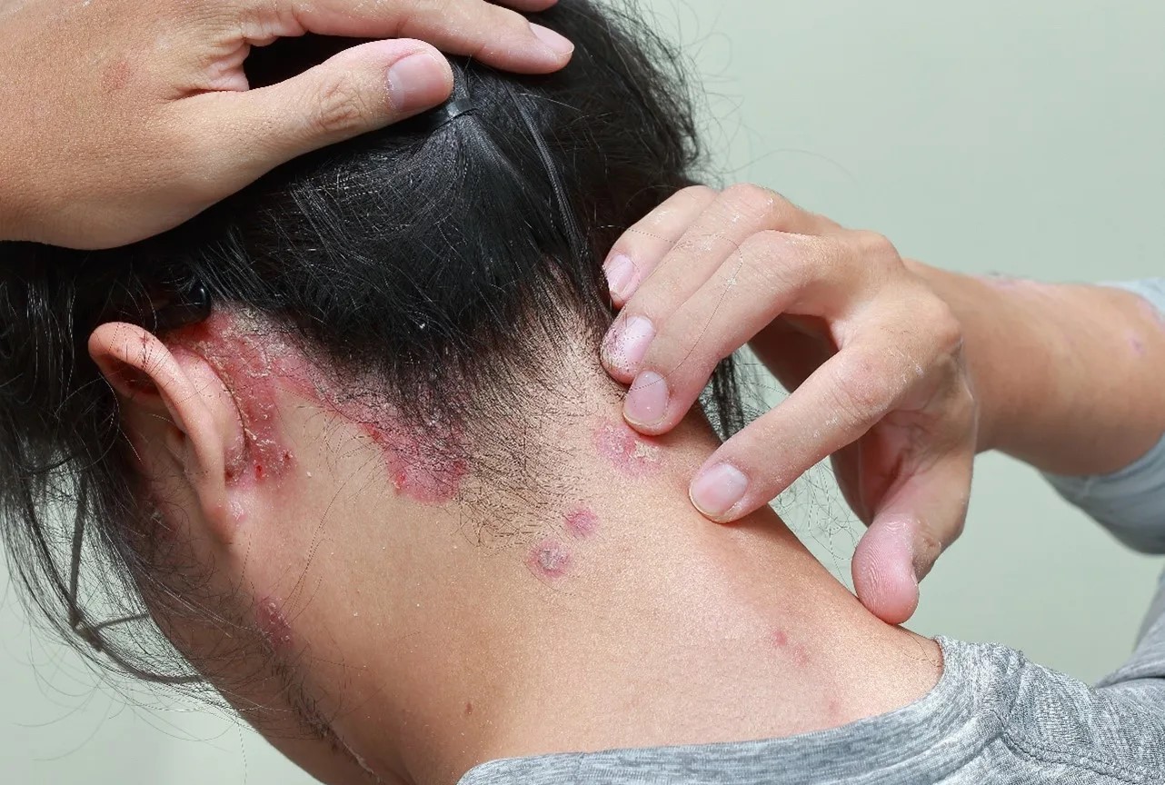 درمان خانگی پسوریازیس سر