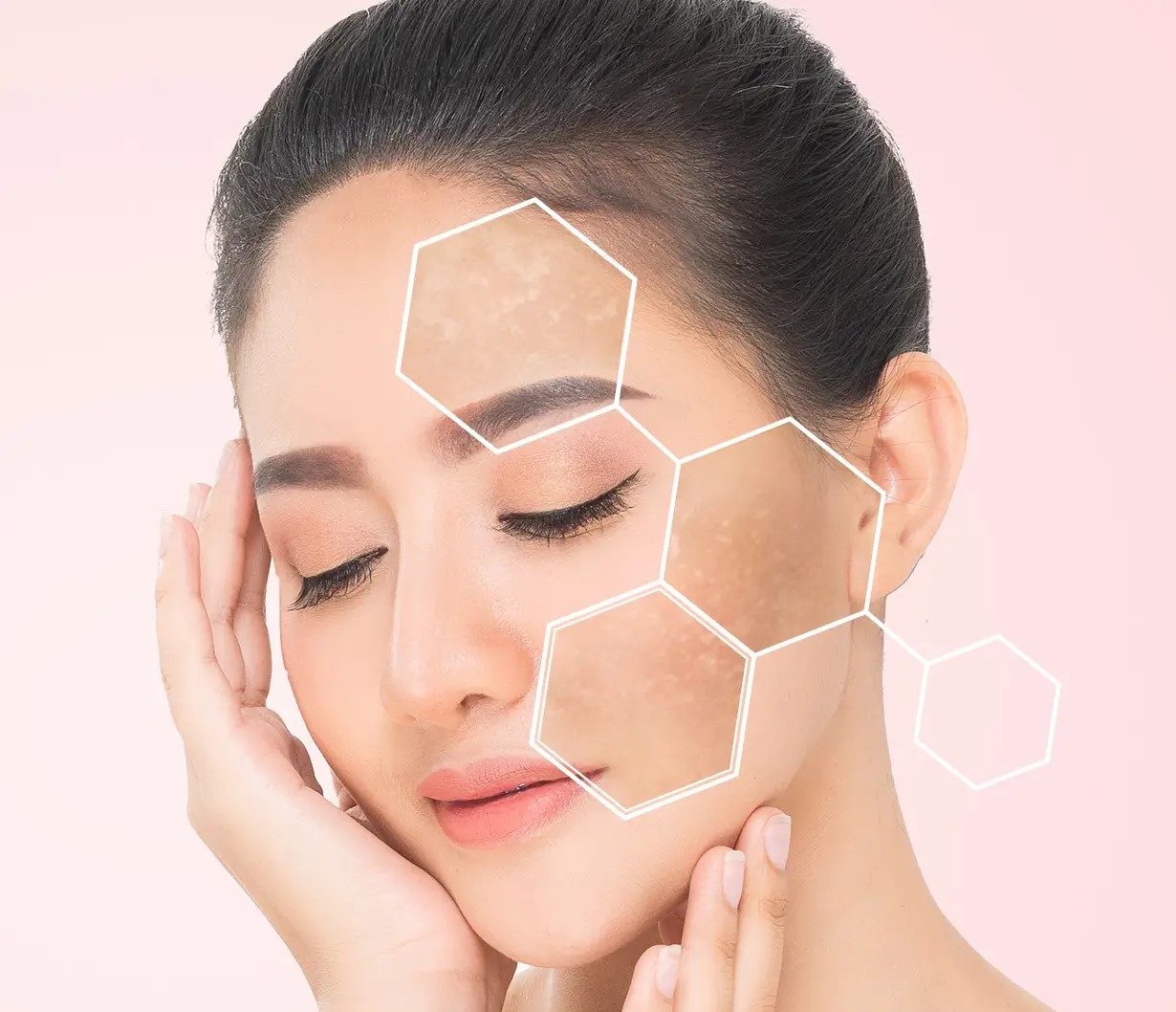 درمان لک پوستی - کمبود ویتامین و لک صورت