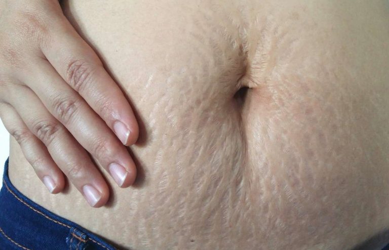 درمان ترک پوستی ناشی از چاقی