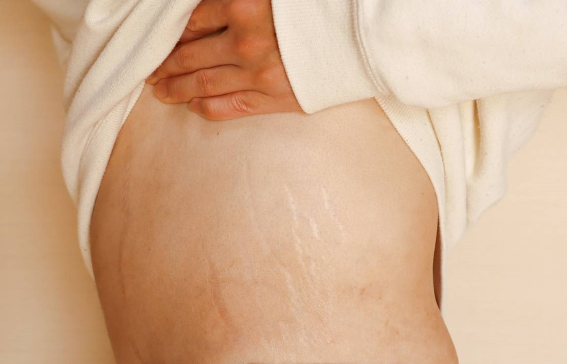 درمان ترک پوستی در خانه - درمان ترک پوستی ناشی از چاقی