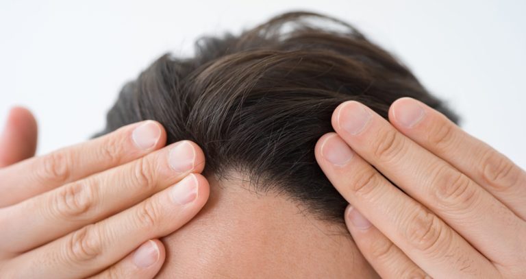 ریزش موی آندروژنیک