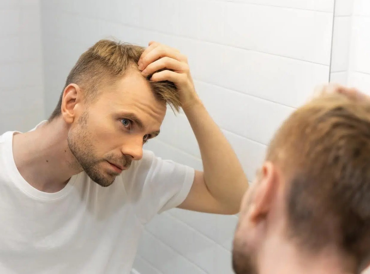 ریزش مو - ریزش موی آندروژنیک