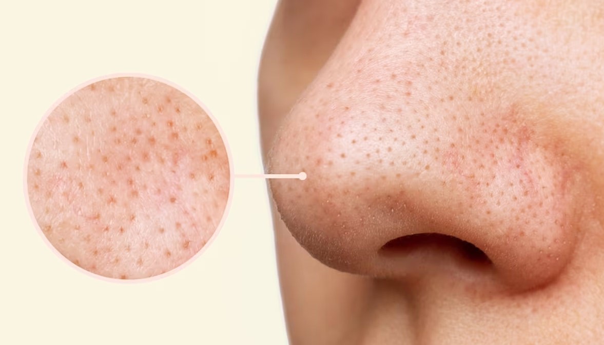 جوش سرسیاه بینی - درمان جوش سر سیاه در خانه