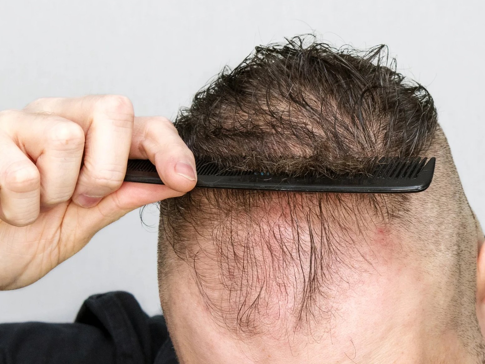 ریزش موی آندروژنیک مردانه