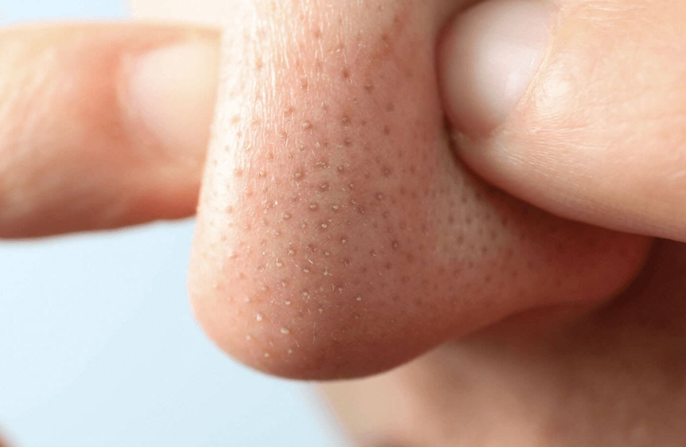 ماسک بینی - درمان جوش سر سیاه در خانه