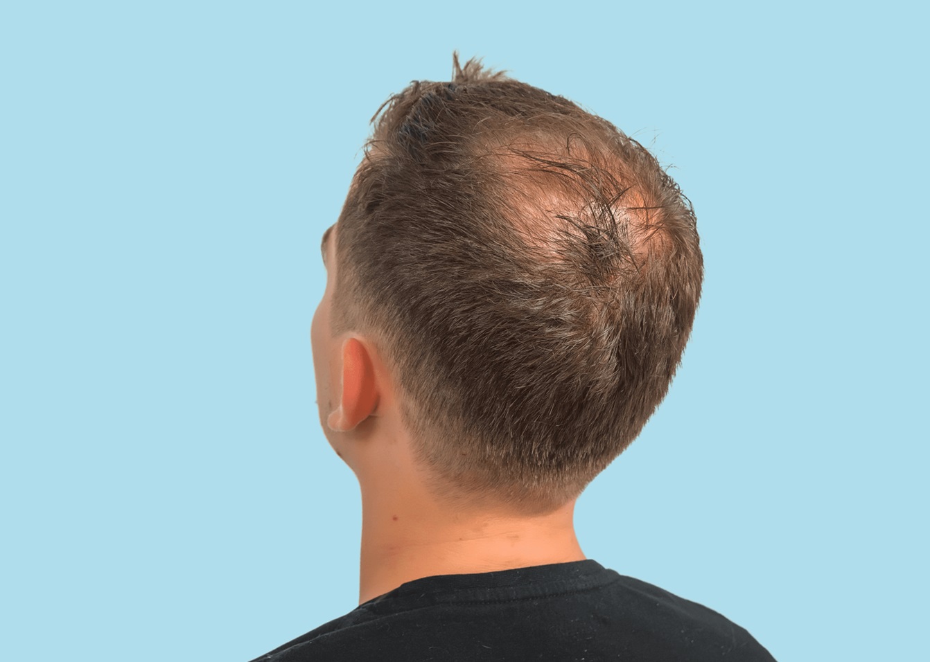 ریزش موی ارثی - ریزش موی آندروژنیک