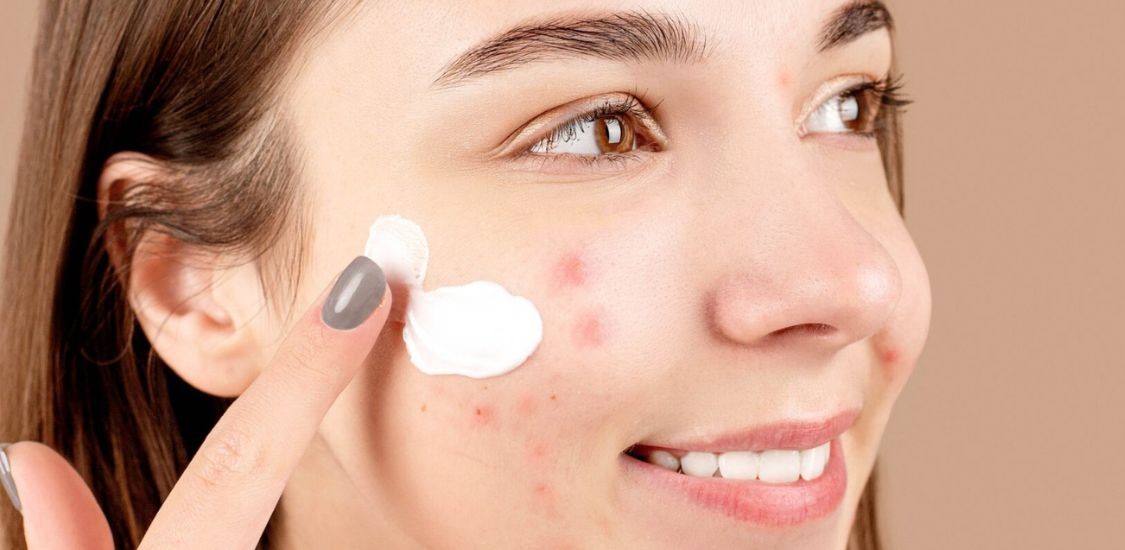 پماد برای جاش جوش - بهترین پماد برای جای جوش صورت