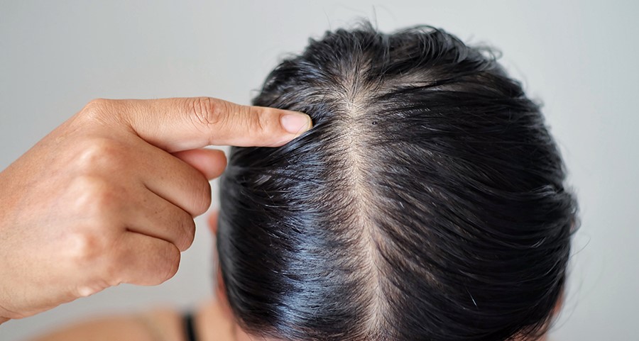 از بین بردن چربی سر - درمان چربی موی سر