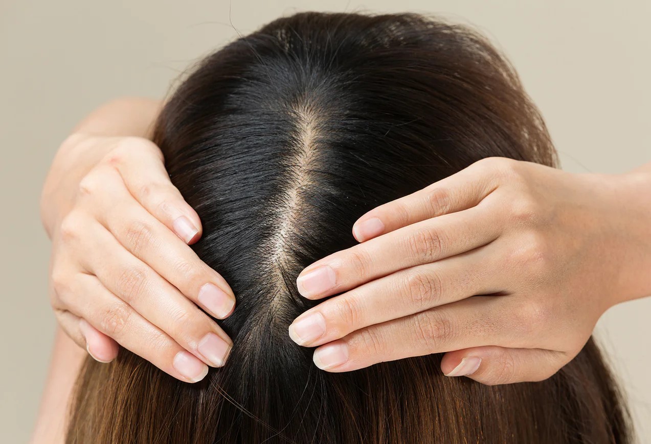 چربی سر - درمان چربی موی سر