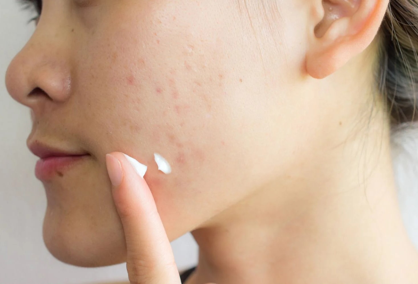 پماد برای جوش - بهترین پماد برای جای جوش صورت