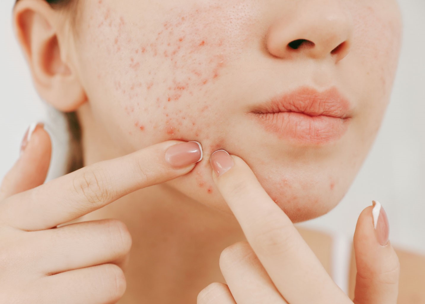 درمان جوش صورت - بهترین پماد برای جای جوش صورت