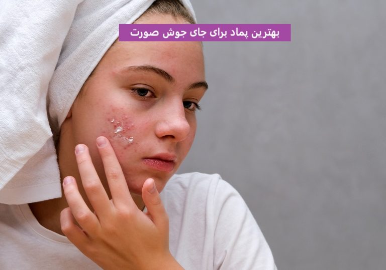 بهترین پماد برای جای جوش صورت
