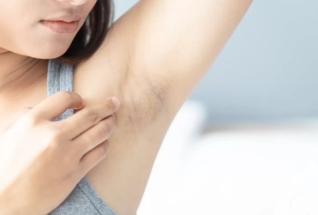 رفع تیرگی زیر بغل در یک روز