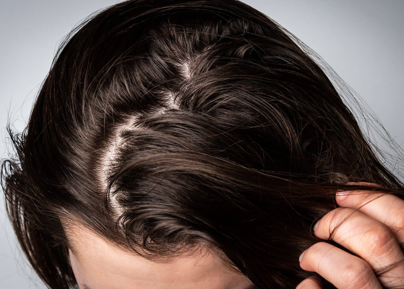 چربی کف سر - درمان چربی موی سر