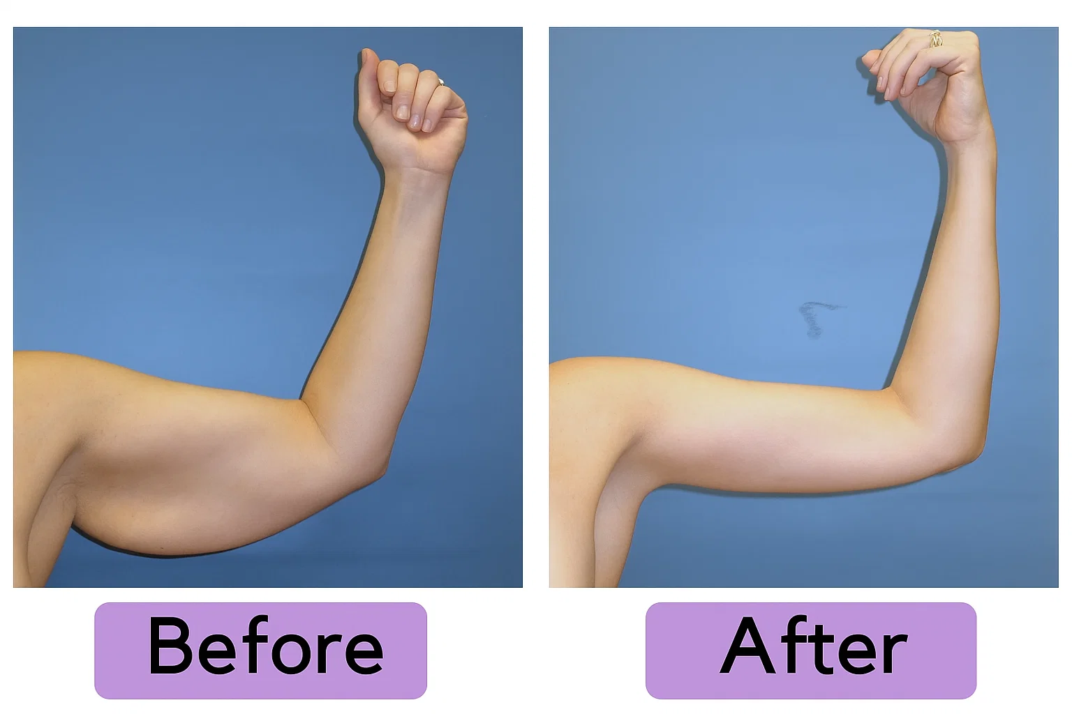 رفع افتادگی و شل شدن بازو