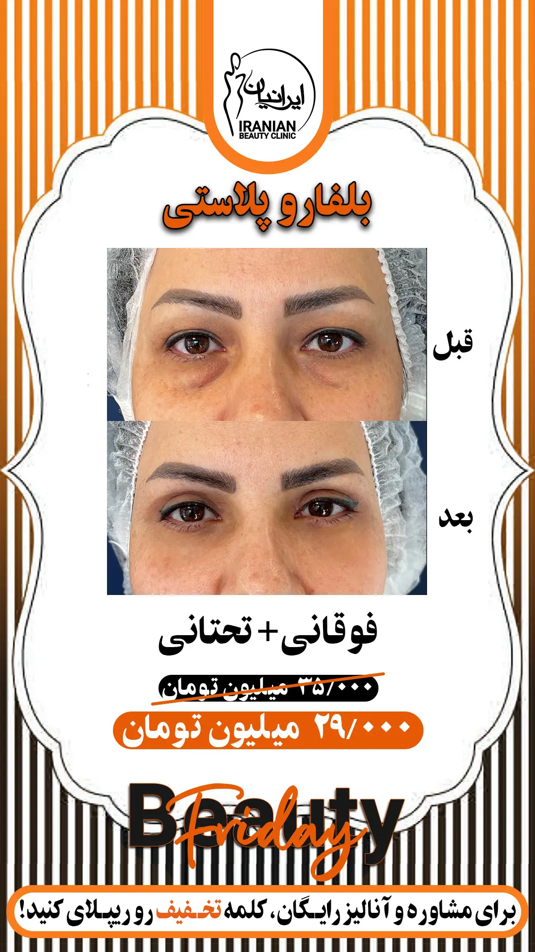 بلفارو پلاستی