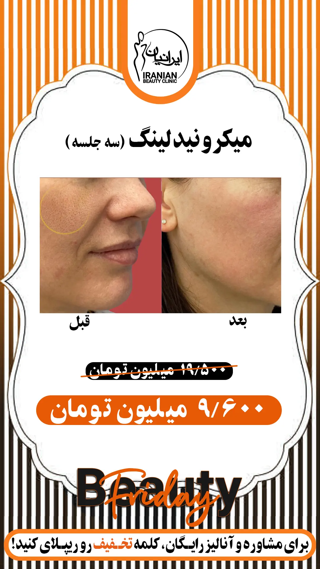 میکرونیدلینگ