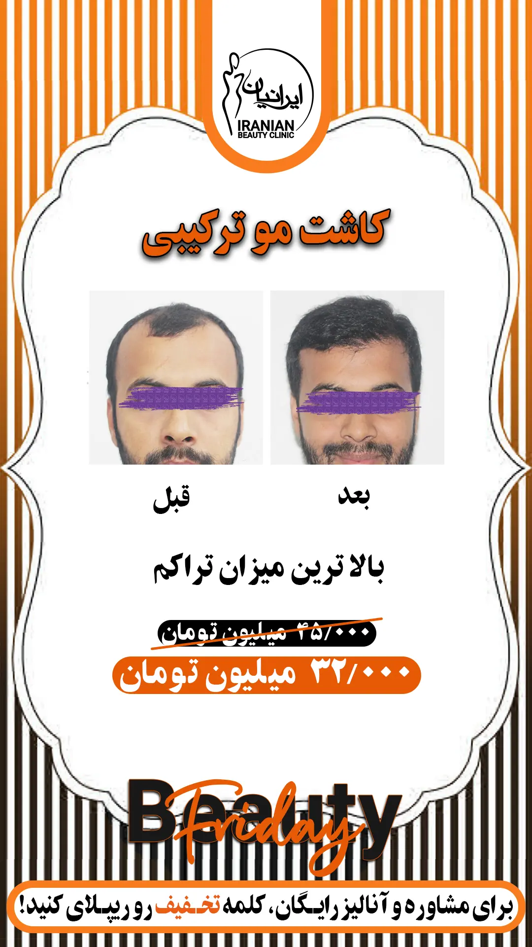 کاشت مو ترکیبی